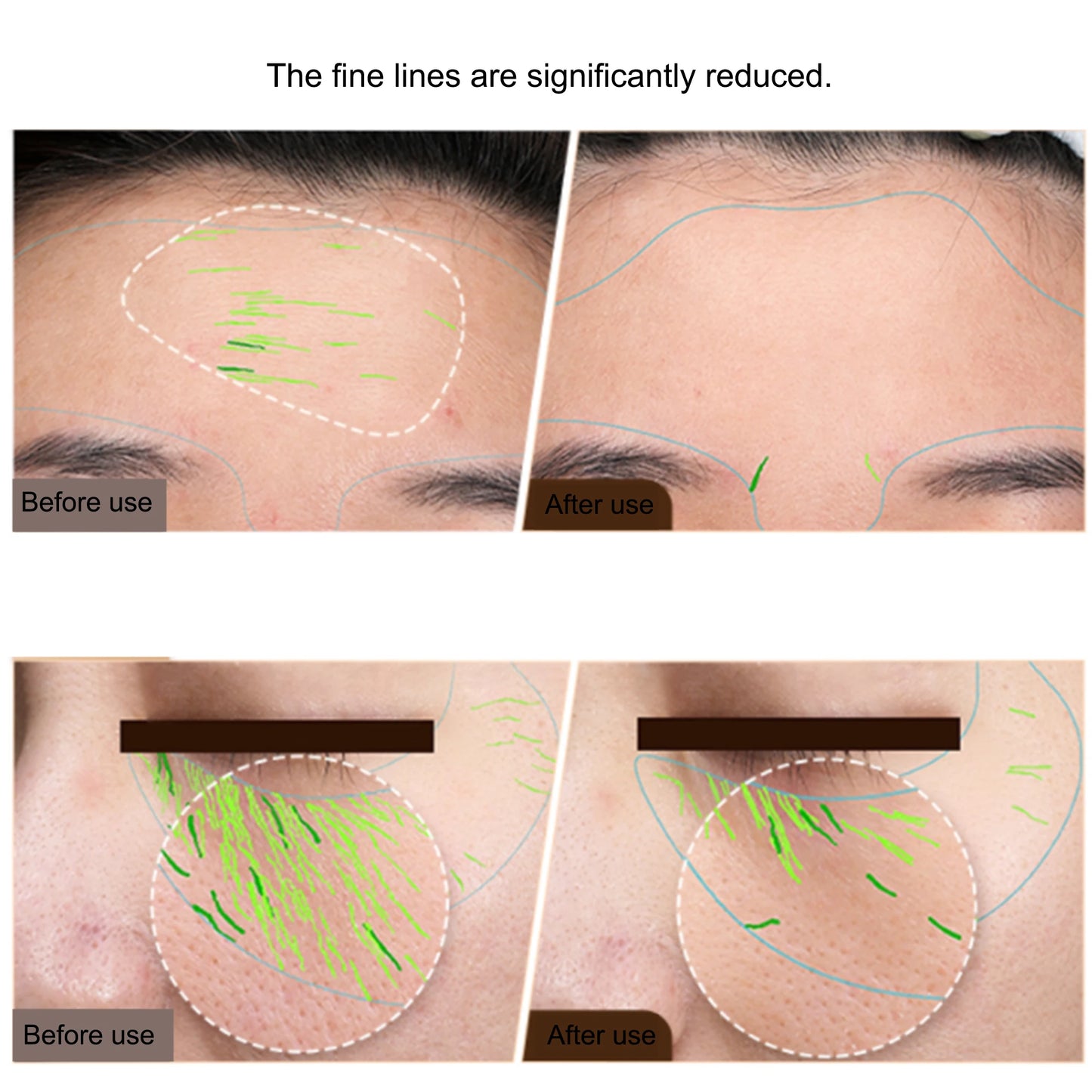 Ems Facial Body Radio Frequency