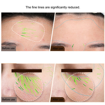 Ems Facial Body Radio Frequency