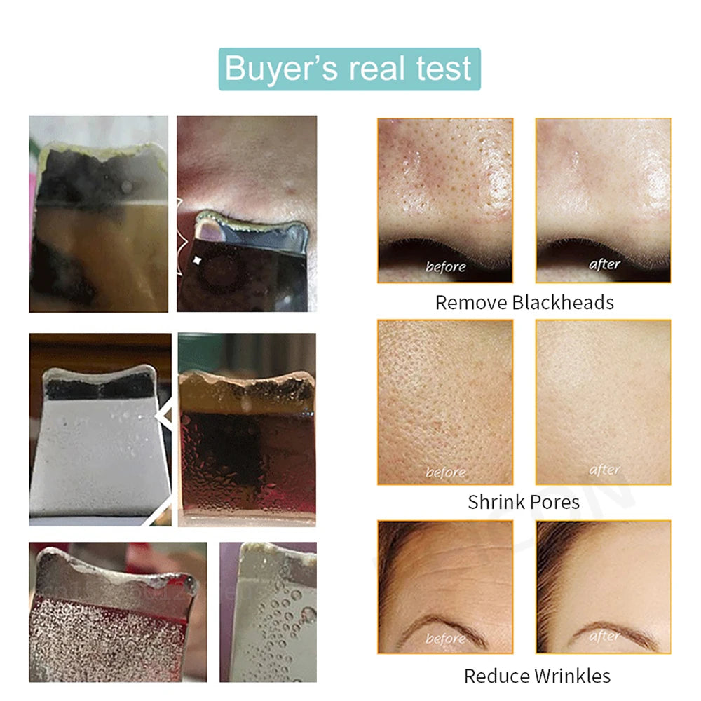 Ultrasonic Skin Scrubber Peeling Blackhead