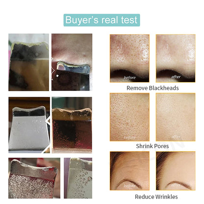 Ultrasonic Skin Scrubber Peeling Blackhead